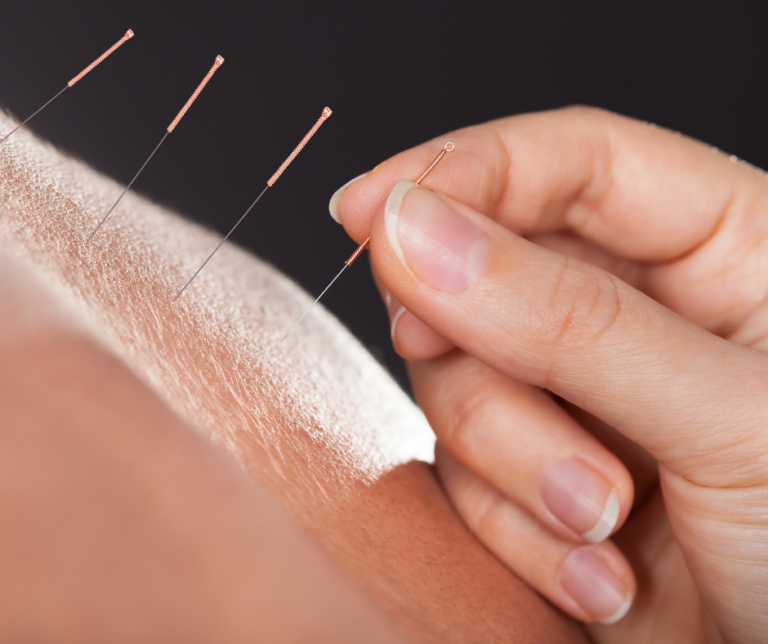 What is Acupuncture? Active Osteopathy