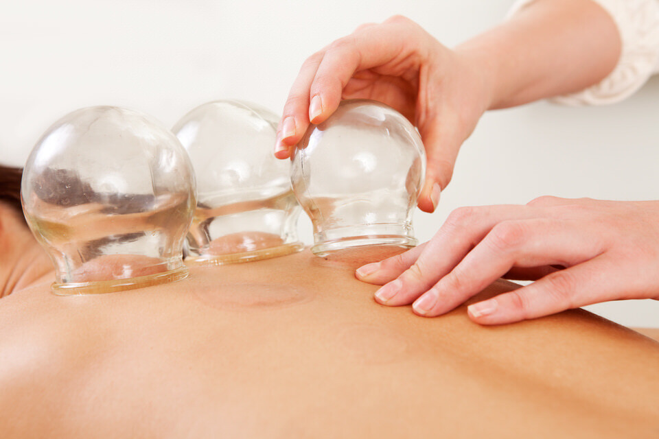 Cupping Pukekohe Osteopath